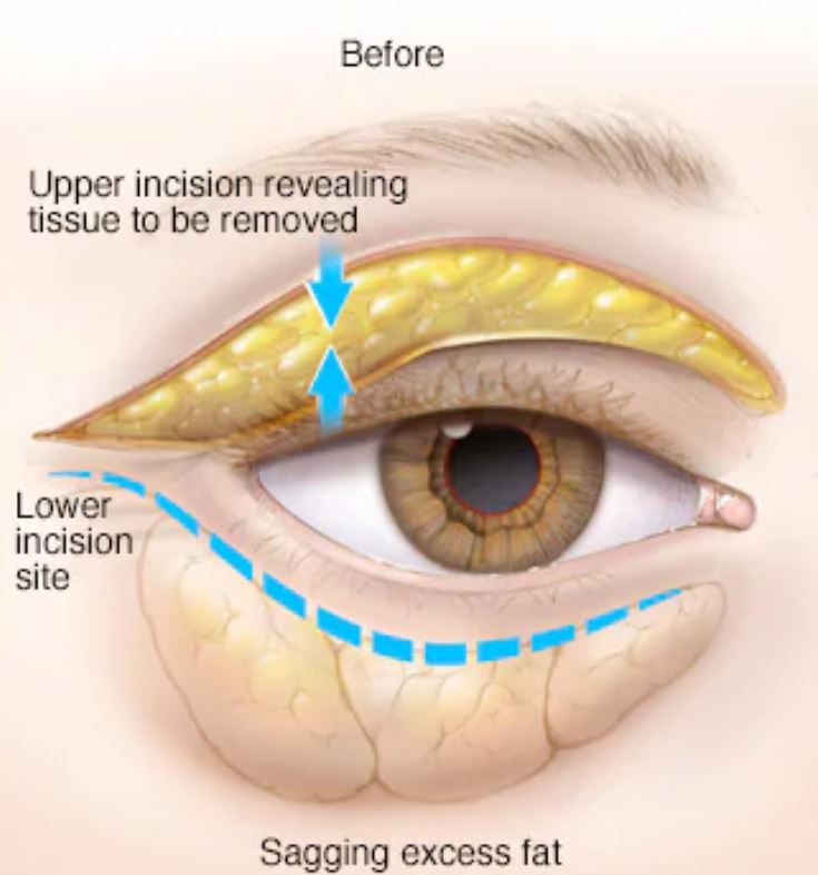 Subciliary Ridge Blepharoplasty – Spyrou Clinic