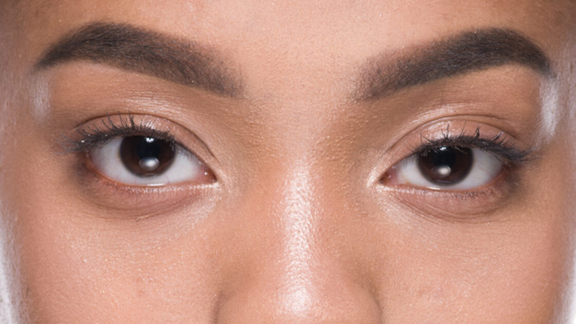 Blepharoplasty