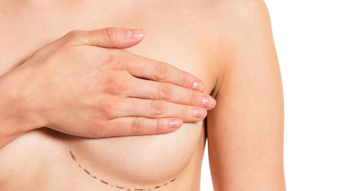 Augmentation Mastopexy (Uplift with Implants)